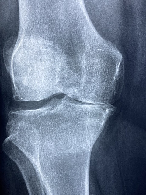 x rays, hip dysplasia
